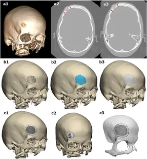 コンパス顔面骨骨折の治療 : Clinical Operation Manua… コンパス顔面骨骨折の治療 ベーシック編 | 坂本好昭 |本 | 通販
