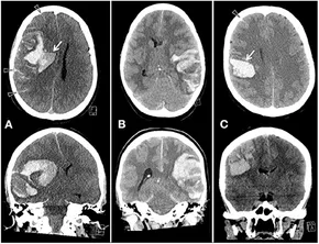 A11290613]Thrombosis Medicine Vol.7 No.4(2017 特集:外傷性