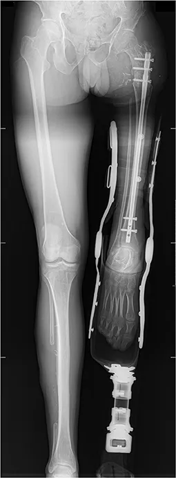 Percutaneous-Reinforced Osteoplasty: A Review of Emerging