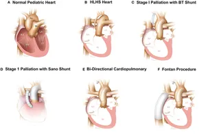 健康・医学 Hypoplastic Left Heart Syndrome Hypoplastic left heart syndrome: MedlinePlus Medical
