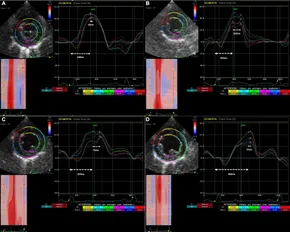Frontiers | Left ventricular dyssynchrony as marker of early