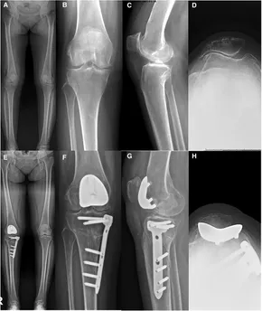 Knee Osteotomy アップデート ゼロからはじめる! Knee Osteotomyアップデート | 日本 Knee