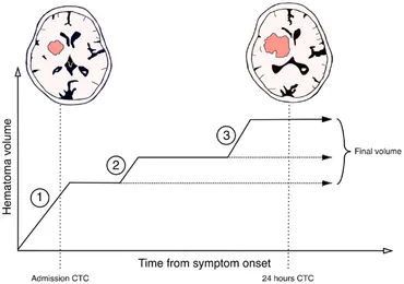 New Insights in Intracerebral Hemorrhage (Frontiers of Neurology and Neuroscience) [ハードカバー] Toyoda， Kazunori? Anderson， Craig S.; Mayer， Stephan A. Amazon.com: New Insights in Intracerebral Hemorrhage