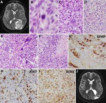 Tumor 89Zr-PET imaging to predict tumor uptake of 177Lu-NNV003