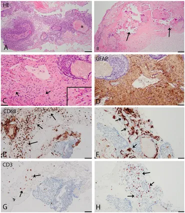 Frontiers | Tocilizumab for the fifth progression of cystic