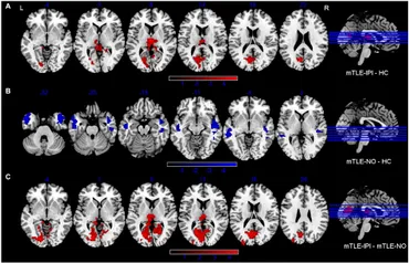 Frontiers | Alterations in static and dynamic regional