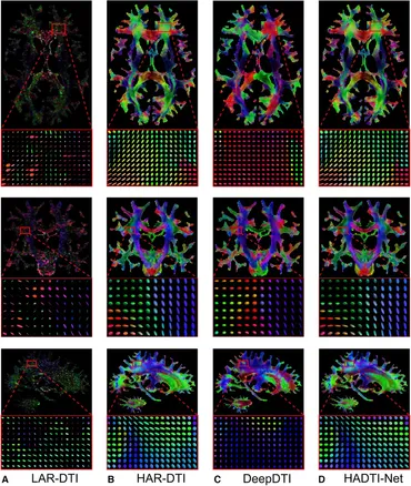 Frontiers | High angular diffusion tensor imaging estimation