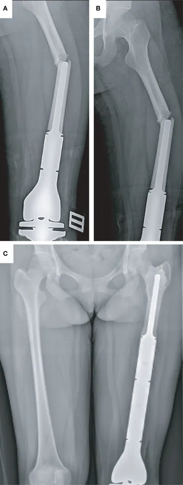 Frontiers | Revision surgery for periprosthetic fracture of