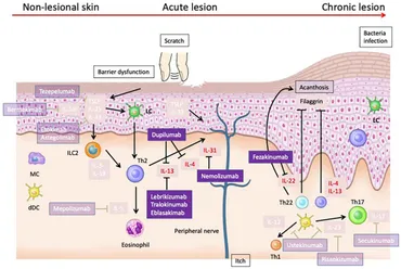 その他 Pathogenesis and Management of Atopic Full article: Pathogenesis of atopic dermatitis: A short review