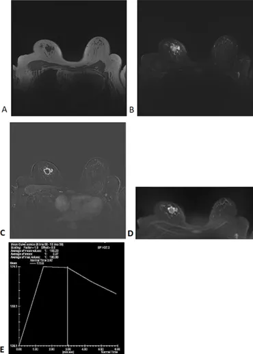 健康・医学 Preneoplasia of the Breast 71RapDugTOL.jpg
