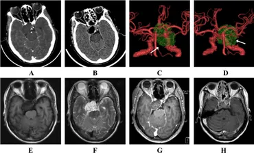 Frontiers | Case Report: Collision tumors of the sellar