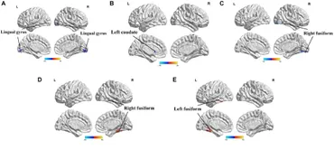 Frontiers | The Effects of SNCA rs894278 on Resting-State