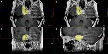脳神経外科  Cavernous Sinus 脳神経外科 Cavernous Sinus Cavernous Sinus and Its Cranial