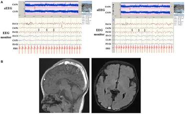 eeg 2012年 Using amplitude-integrated EEG in neonatal intensive care