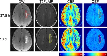 Automated MRI perfusion-diffusion mismatch estimation may be