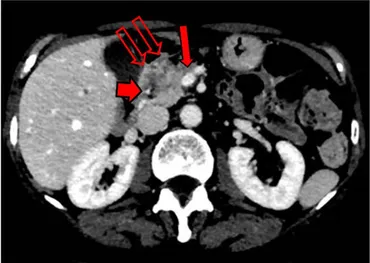 Tumors of the Pancreas (Afip Atlas of Tumor Pathology; 4th