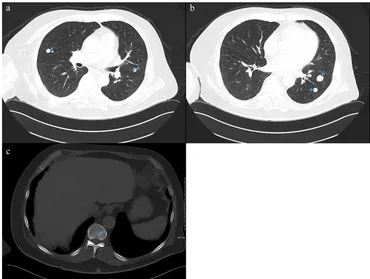 ファロー四徴症（TOF）術後の血管形態評価 ｜ Search Radiology