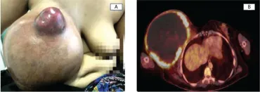 健康・医学 Breast Cancer Researchers Identify Possible New Risk for Breast Cancer