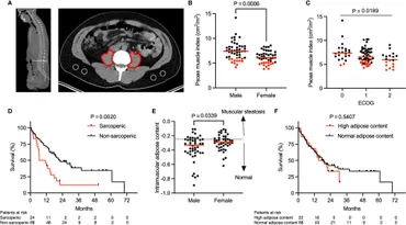 Adjuvant chemotherapy for pulmonary sarcomatoid carcinoma: A