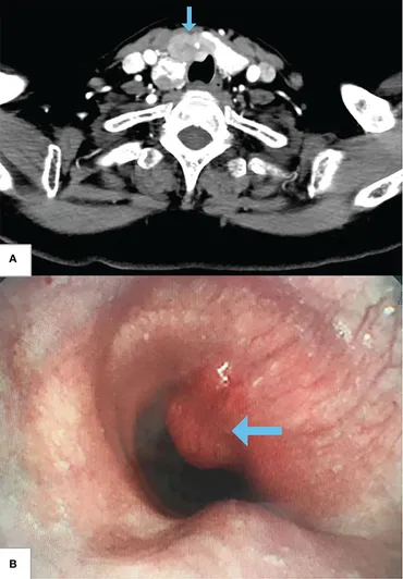 Molecular Imaging and Theragnostics of Thyroid Cancers