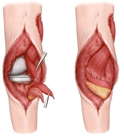 gracilis model