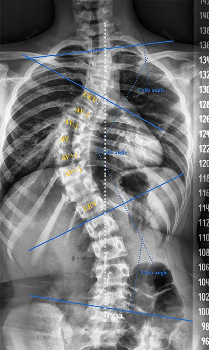 Frontiers | Evaluating bone quality and asymmetrical aplasia