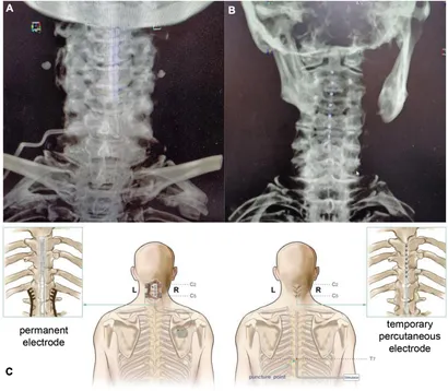 人体模型　脳脊髄循環Cerebrospinal FluidCirculation Cerebrospinal Fluid Dynamics Treatment Mount Dora, FL