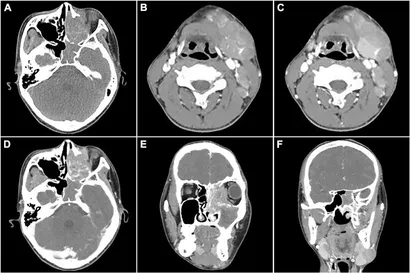 MRI and CT Atlas of Correlative Imaging in Otolaryngology Flanders， Adam E、 Rao， Vijay M; Tom， Barry M OJHAS: 2024-1-11. Beegum F, Vijayanarayanan A, Attakkil A