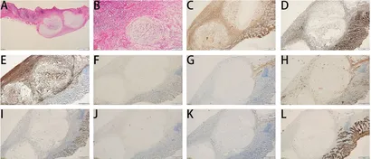 Frontiers | Endoscopic submucosal excavation for gastric