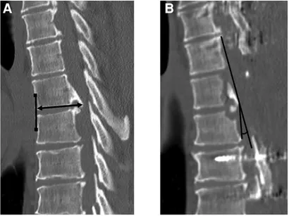 Frontiers | Anterior shift of the ventral dura mater: A
