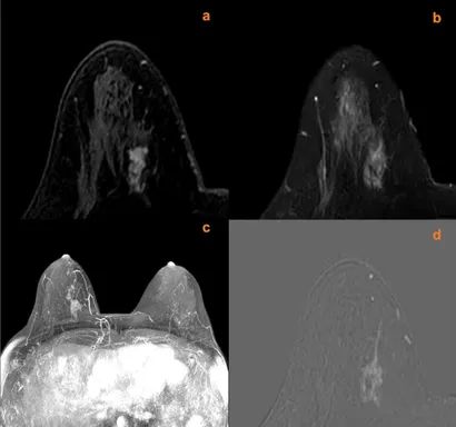 Diagnostic Breast Imaging 第2版 Diagnostic Imaging: Breast: 9781931884730: Medicine & Health