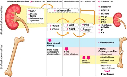 健康・医学 CKD-MBD: Chronic Kidney Disease Mineral Chronic Kidney Disease—Mineral and Bone Disorder (CKD-MBD