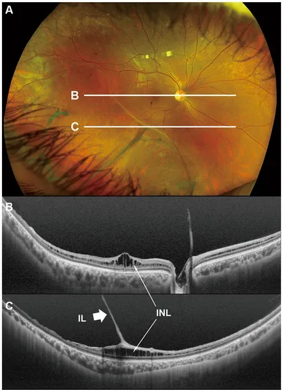 語学+参考書 Electrodiagnosis of retinal di Imaging Considerations in Pathologic Myopia - Retina Today