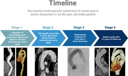 洋書 Surgical and Endovascular Treatment of A Comprehensive Vascular and Endovascular Surgery: Expert