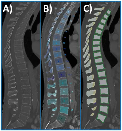 脊椎脊髄病学 = PRINCIPLES OF SPINAL DISORDERS Genetics and pathogenesis of scoliosis - North American