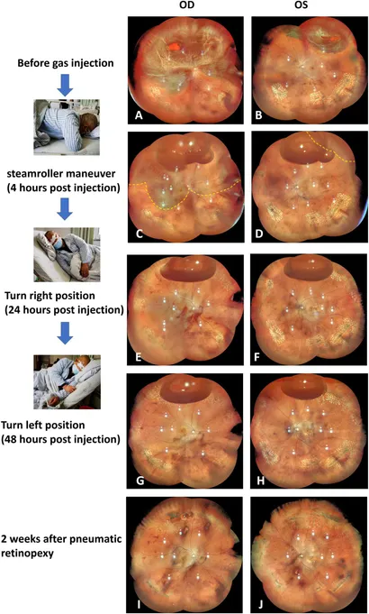 りた Frontiers | Case report: Advanced modified pneumatic retinopexy