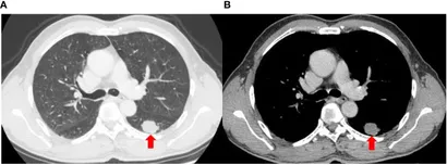 Frontiers | Successful treatment with tislelizumab plus