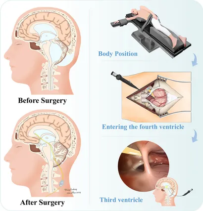 Peritoneal Surgery   医学書 PITUITARY SURGERY - A MODERN APPROACH E.R. Laws Jr, J.P.
