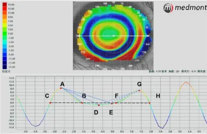 Frontiers | Analysis of corneal surface shape following