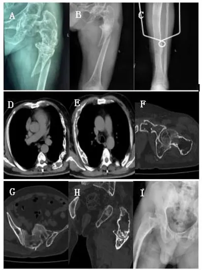 大腿骨近位部骨折 Osteosynthesis & Arthroplasty Osteosynthesis and outcomes of traumatic periprosthetic
