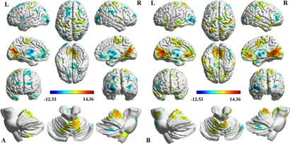 Frontiers | Thalamic functional dysconnectivity in patients Frontiers | Thalamic functional dysconnectivity in patients