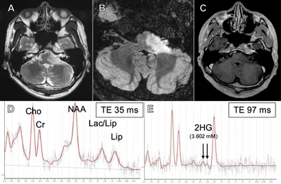 Frontiers | Case Report: Improved hearing in a rare, adult
