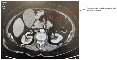 Frontiers | IgG4-related disease - focus on digestive system
