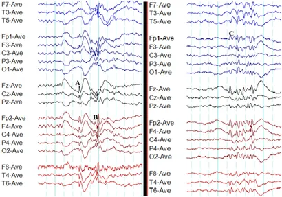 Frontiers | Electroencephalography in the Diagnosis of