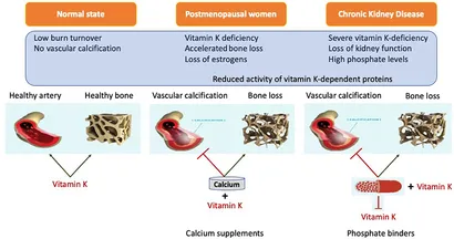 Vitamin K2 and the Calcium Paradox: How a Little-Known