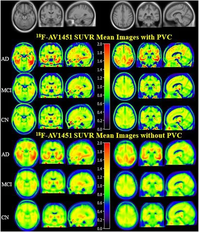 新品稀少/LP/LAST CHILD/PRIVATE SCAN'DAL Head-to-Head Comparison of 11C-PiB and 18F-AZD4694 (NAV4694