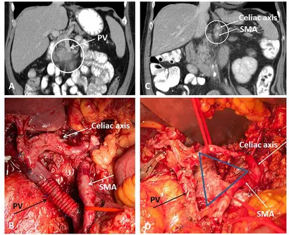 診断病理学：肝胆膵　２版 Hepatobiliary and Pancreas Carcinoma of the Pancreas | The Common Vein