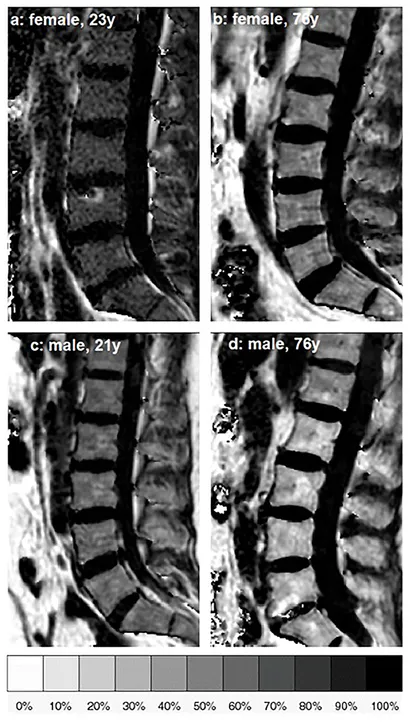 Frontiers | Vertebral Bone Marrow Heterogeneity Using