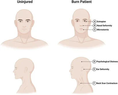 Burns Algorithm - Manual of Medicine