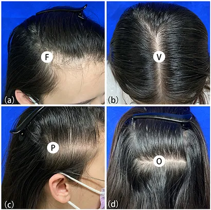 ann Frontiers | Female Pattern Hair Loss in Female and Male: A
